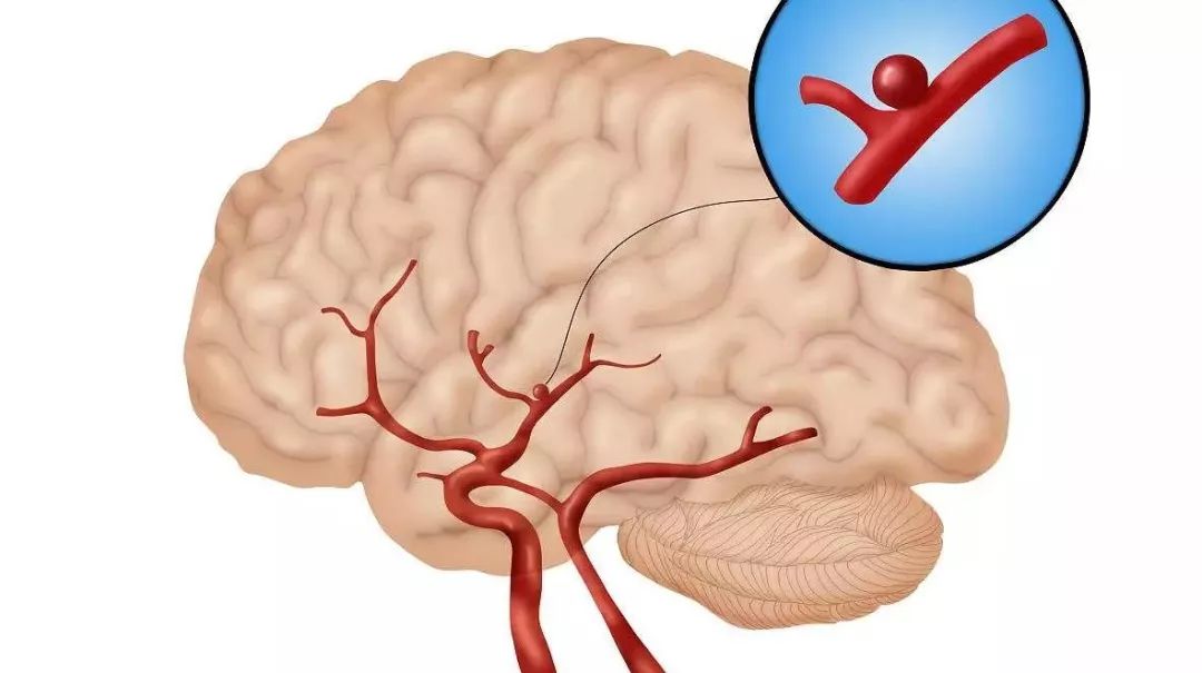 These Devices Are the Weapons to Defeat Brain Aneurysms